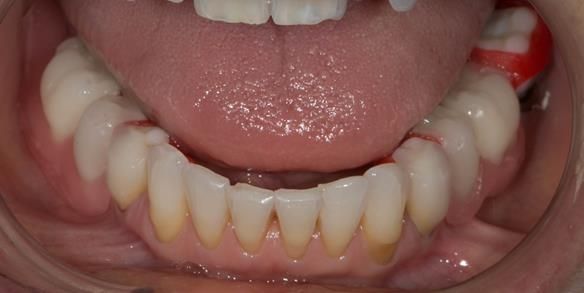 Figure 64 Teeth try in on pattern resin bases in the mouth. These help to confirm the accuracy of the working casts and the amount of metal work which will be visible in the final dentures