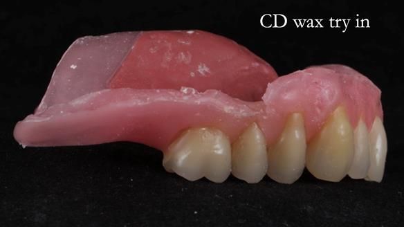 Finlay's Newsletter 62 provision of extractions and metal based complete dentures for Rafique