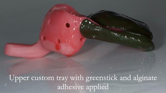 Finlay's Case Study Newsletter 40 - Immediate Mk 1 RPD to Definitive Mk 2 RPD - full protocol