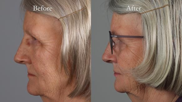 Newsletter 82 Mary - A complete upper and a one-tooth gasket denture