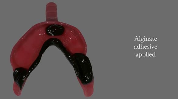 Newsletter 52 Managing Jo’s failing dentition with extractions and Mk 1/Mk 2 complete upper dentures and lower partial dentures FULL PROTOCOL