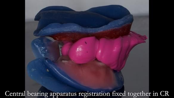 Newsletter 83: Sheila’s Complete Denture Success