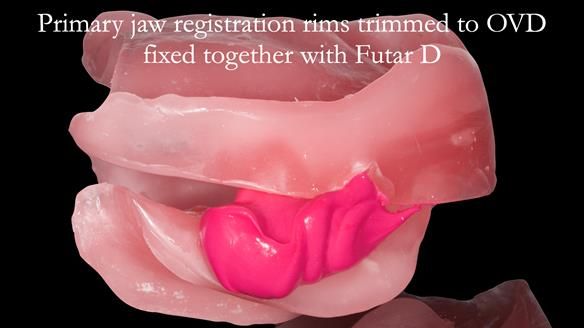 Newsletter 52 Managing Jo’s failing dentition with extractions and Mk 1/Mk 2 complete upper dentures and lower partial dentures FULL PROTOCOL