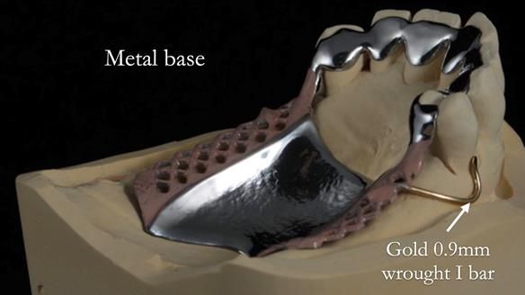 Newsletter 56 showing the making and fitting of a bilateral free end saddle upper removable partial denture (RPD) for patient with pemphigus