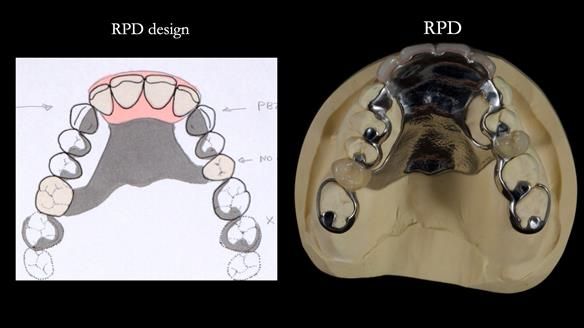 Newsletter 81 - Pam’s Story — how a partial denture changed her life (+ live walkthrough this Thursday)