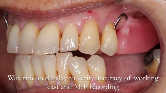 Newsletter 56 showing the making and fitting of a bilateral free end saddle upper removable partial denture (RPD) for patient with pemphigus