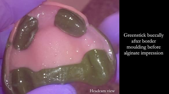 Newsletter 82 Mary - A complete upper and a one-tooth gasket denture