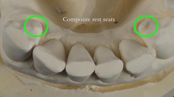 Finlay's Newsletter 61 provision of a lower unilateral free end saddle metal based partial denture for Joyce