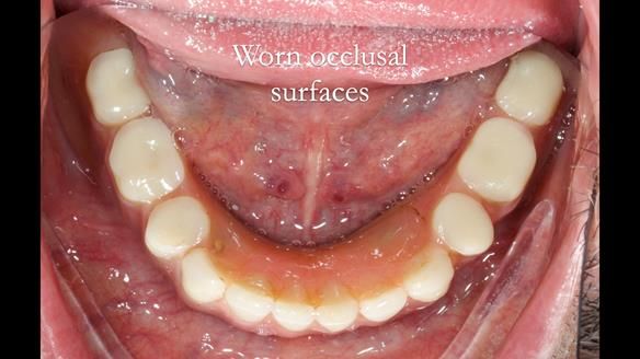 Newsletter 78: What do Clark Gable and a Locator® overdenture have in common?