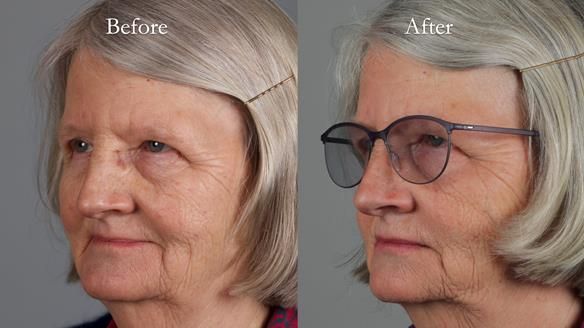 Newsletter 82 Mary - A complete upper and a one-tooth gasket denture