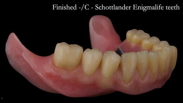 Complete denture Class II div 2 deep overbite Newsletter 39