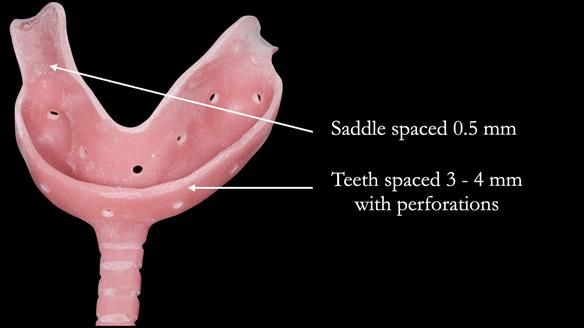Newsletter 52 Managing Jo’s failing dentition with extractions and Mk 1/Mk 2 complete upper dentures and lower partial dentures FULL PROTOCOL