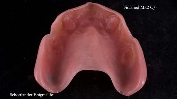 Newsletter 77: Jeremy’s case – immediate complete upper denture