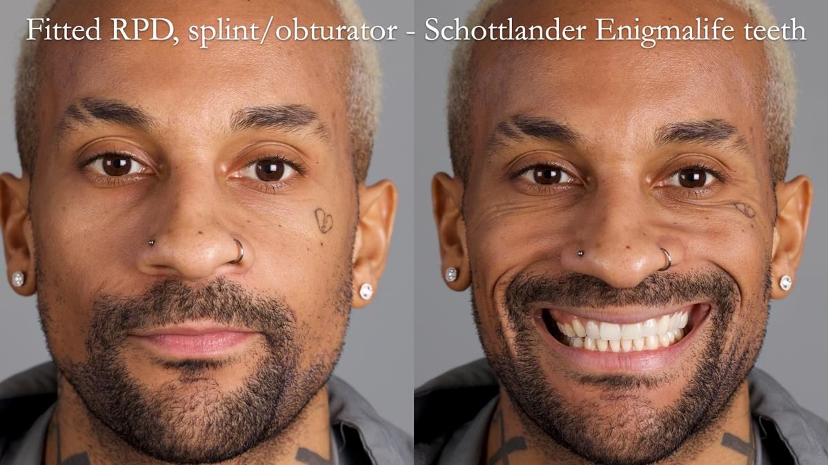 End of treatment - James was delighted with the outcome in terms of comfort, fit and appearance