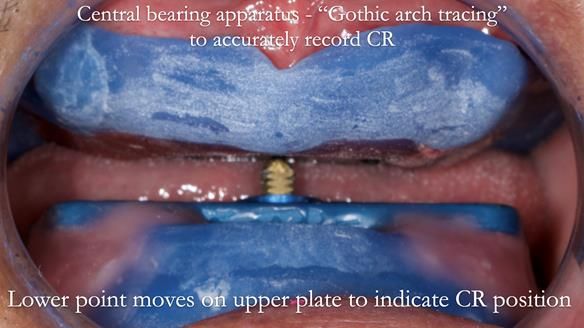 Finlay's Newsletter 62 provision of extractions and metal based complete dentures for Rafique