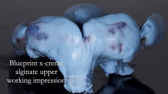 Newsletter 77: Jeremy’s case – immediate complete upper denture