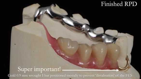 Finlay's Newsletter 61 provision of a lower unilateral free end saddle metal based partial denture for Joyce