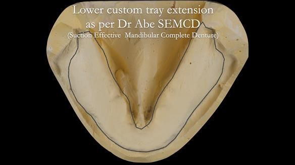 Newsletter 53 showing the making and fitting of ultra life-like dentures for Valena