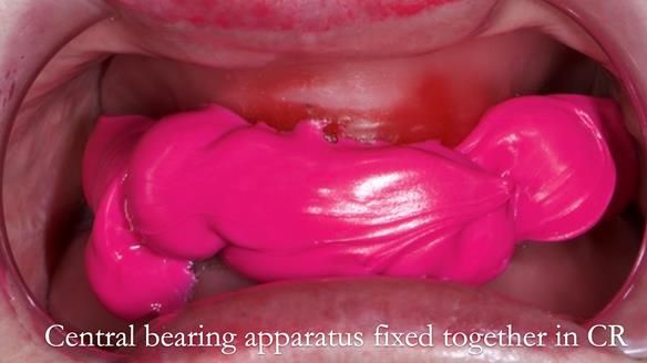 Replacing Madeline’s Complete denture FULL PROTOCOL