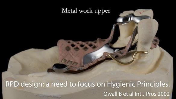 Finlay's Newsletter 59 Ultra hard partial dentures made for Gill