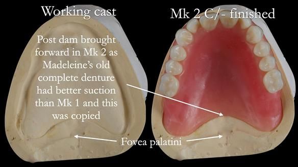 Replacing Madeline’s Complete denture FULL PROTOCOL