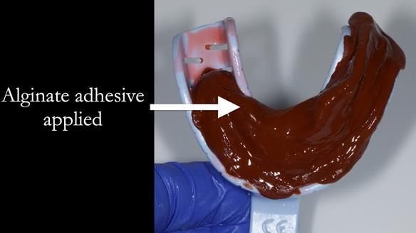 Finlay's Newsletter 59 Ultra hard partial dentures made for Gill