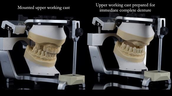 Newsletter 77: Jeremy’s case – immediate complete upper denture