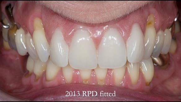 Newsletter 66 Long term case study. Life changing metal based RPD made for Anna
