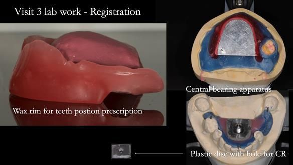 Finlay's Newsletter 58 Gasket upper partial denture for Zoe