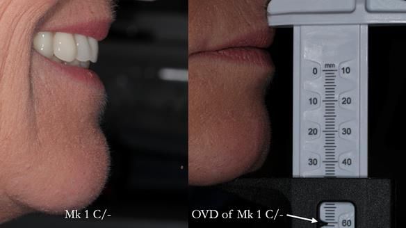 Newsletter 52 Managing Jo’s failing dentition with extractions and Mk 1/Mk 2 complete upper dentures and lower partial dentures FULL PROTOCOL