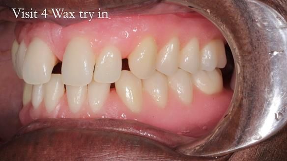 Newsletter 53 showing the making and fitting of ultra life-like dentures for Valena