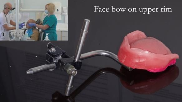 Managing poor implant positioning with complete dentures and Locator attachments - full protocol Newsletter 41