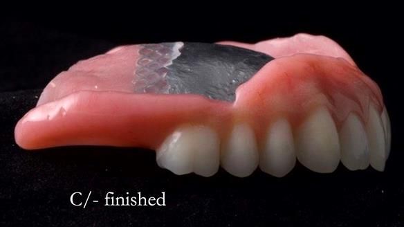 Managing poor implant positioning with complete dentures and Locator attachments - full protocol Newsletter 41