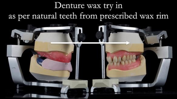 Newsletter 53 showing the making and fitting of ultra life-like dentures for Valena