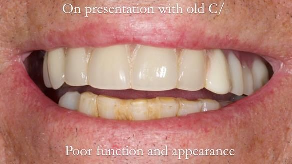 Newsletter 54 case presentation upper complete denture and lower Scandinavian designed hygienic partial denture for David