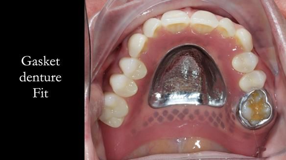 Finlay's Newsletter 58 Gasket upper partial denture for Zoe