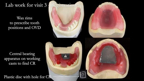 Newsletter 76: Jackie’s case – Telescopic overdenture & precision RPD (the tricky truth!)
