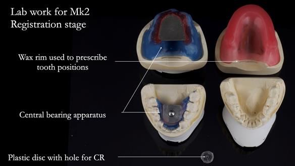 Newsletter 77: Jeremy’s case – immediate complete upper denture