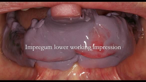 Newsletter 76: Jackie’s case – Telescopic overdenture & precision RPD (the tricky truth!)