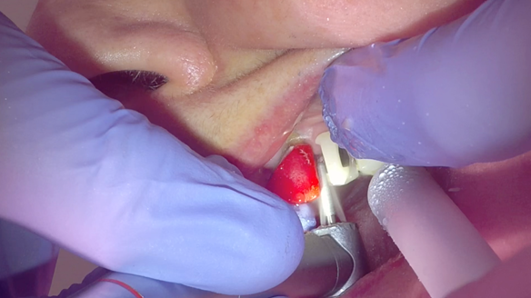 Figure 29 Preparation guides for sectioning the bridges to create guide surfaces allowing accurately fitting immediate dentures