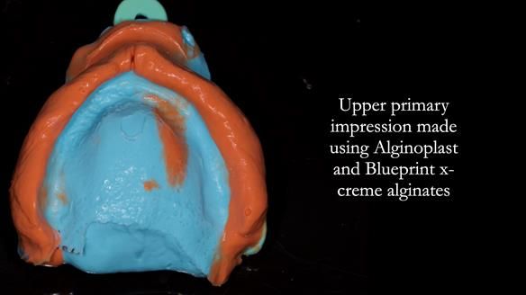 Newsletter 82 Mary - A complete upper and a one-tooth gasket denture