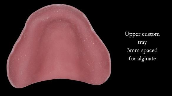 The upper custom tray is spaced by 2 layers of wax – 3mm for alginate or silicone impressions. This is short of the depth of the sulcus all the way round the periphery by 2 mm. In the post dam region the tray is extended 1mm beyond the fovea palatini.
