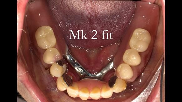Finlay's Case Study Newsletter 40 - Immediate Mk 1 RPD to Definitive Mk 2 RPD - full protocol