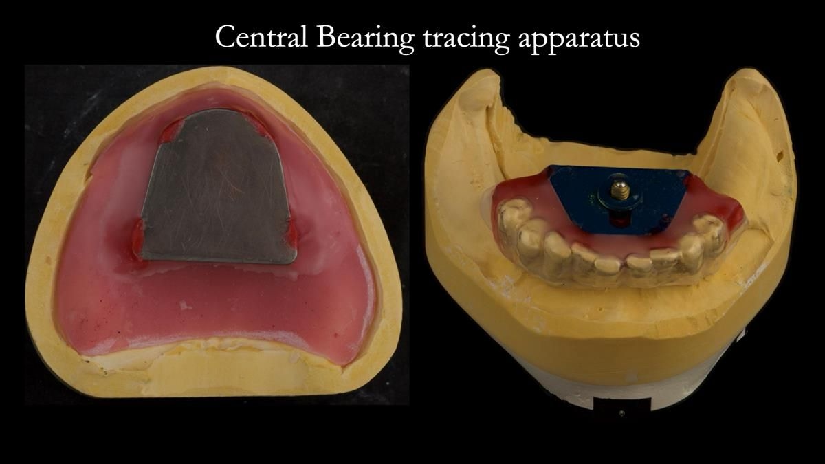 Newsletter 87 – Father Peter: A Partial Denture that needed Minor Miracle