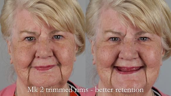 Replacing Madeline’s Complete denture FULL PROTOCOL