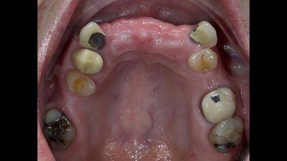 Newsletter 81 - Pam’s Story — how a partial denture changed her life (+ live walkthrough this Thursday)