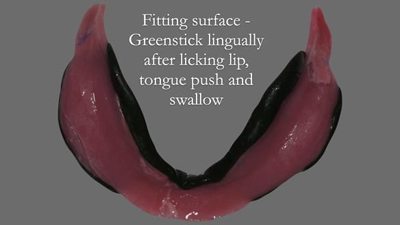 Finlay's Newsletter 62 provision of extractions and metal based complete dentures for Rafique