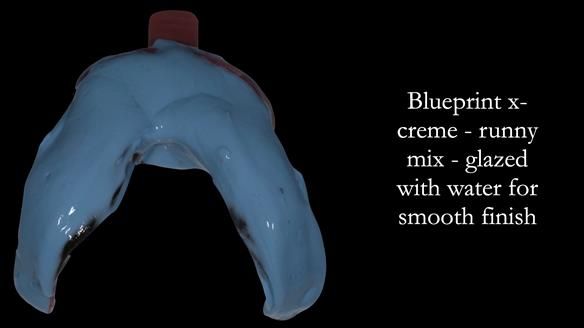 Newsletter 52 Managing Jo’s failing dentition with extractions and Mk 1/Mk 2 complete upper dentures and lower partial dentures FULL PROTOCOL