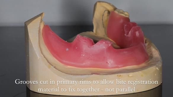 Finlay's Newsletter 59 Ultra hard partial dentures made for Gill