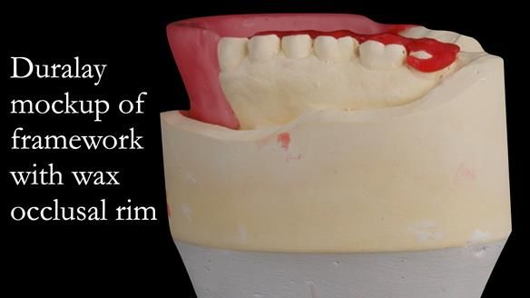 Upper metal base partial denture/occlusal stabilisation splint/obturator - full protocol